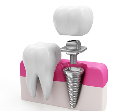 dental implant