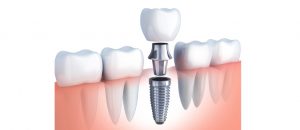 illustration of a dental implant