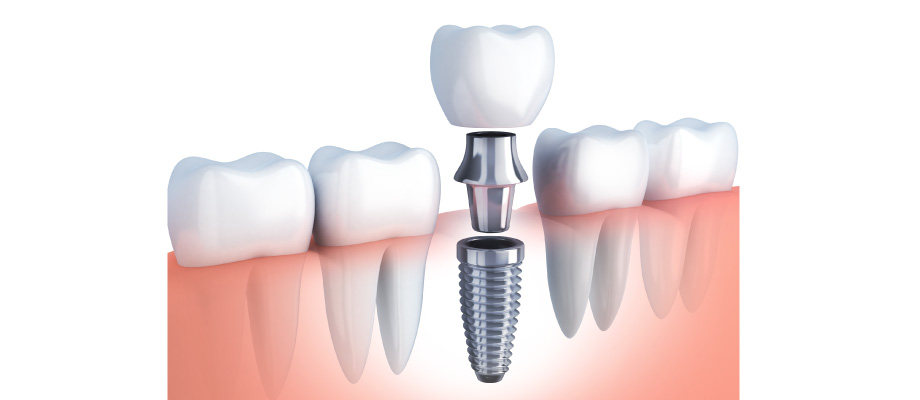 illustration of a dental implant