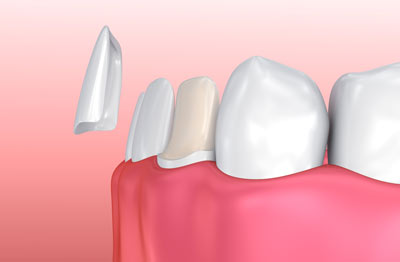 Diagram of a porcelain veneer being placed on a tooth